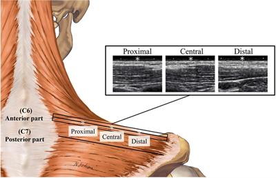 Intramuscular stiffness distribution in anterior and posterior upper trapezius muscles in healthy young males